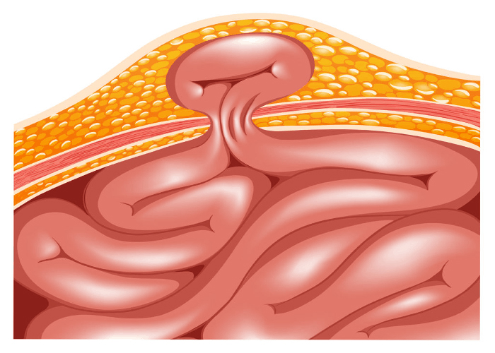 laparoscopic